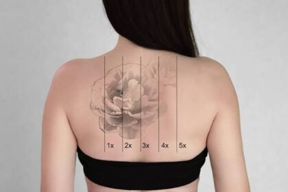 Tattoo Removal