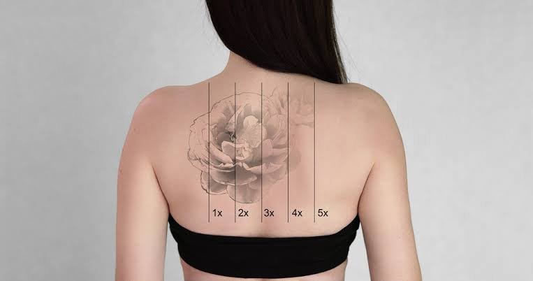 Tattoo Removal